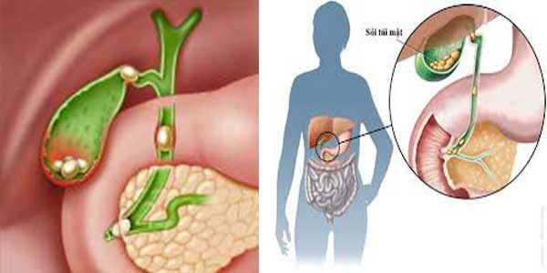 Mất mật vì chủ quan với sỏi: BS cảnh báo dấu hiệu cần khám ngay kẻo biến chứng nguy hiểm - Ảnh 2.