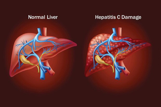 WHO cảnh báo: Việt Nam có gần 1 triệu ca nhiễm virus viêm gan C, cần chủ động phòng ngừa ngay các con đường dễ lây nhiễm - Ảnh 2.