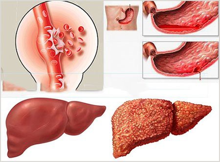 34 tuổi đã xơ gan giai đoạn cuối: Bác sĩ chỉ tận mặt thủ phạm gây ra 70% trường hợp xơ gan - Ảnh 2.