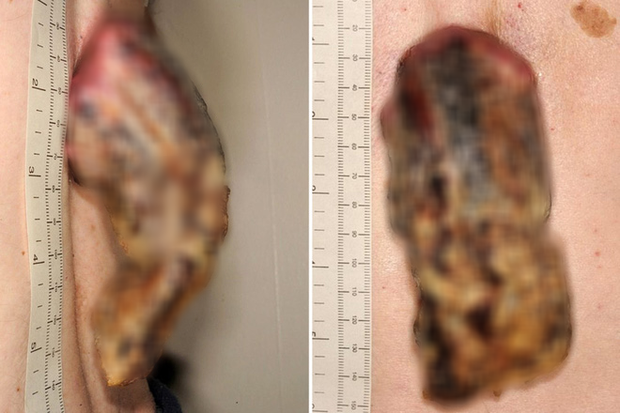 Phớt lờ miếng da nhỏ sần sùi trên lưng, 3 năm sau người đàn ông tá hỏa khi nó biến thành một cái ‘sừng’ 14cm bị ung thư - Ảnh 1.