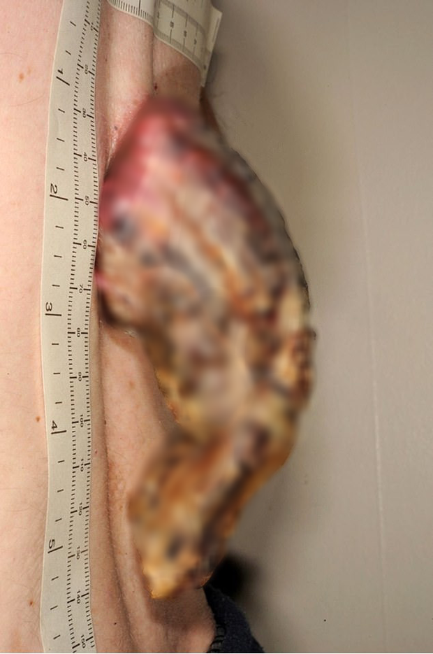 Phớt lờ miếng da nhỏ sần sùi trên lưng, 3 năm sau người đàn ông tá hỏa khi nó biến thành một cái ‘sừng’ 14cm bị ung thư - Ảnh 2.