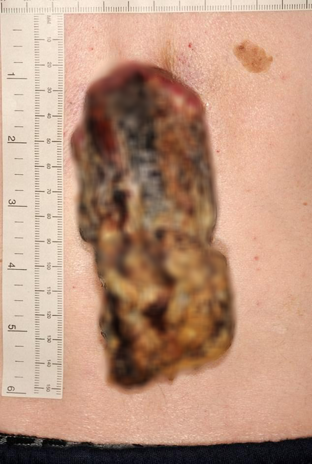 Phớt lờ miếng da nhỏ sần sùi trên lưng, 3 năm sau người đàn ông tá hỏa khi nó biến thành một cái ‘sừng’ 14cm bị ung thư - Ảnh 3.