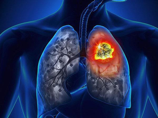 Dấu hiệu nhận biết bệnh viêm phổi cấp - Ảnh 1.