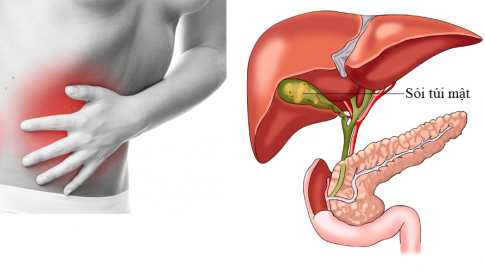 Mất mật vì sỏi: Bà mẹ trẻ 27 tuổi sốc nặng vì thói quen này - Ảnh 1.