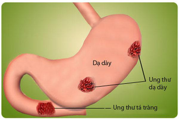 Dưa muối: Lợi, hại thế nào? - Ảnh 2.