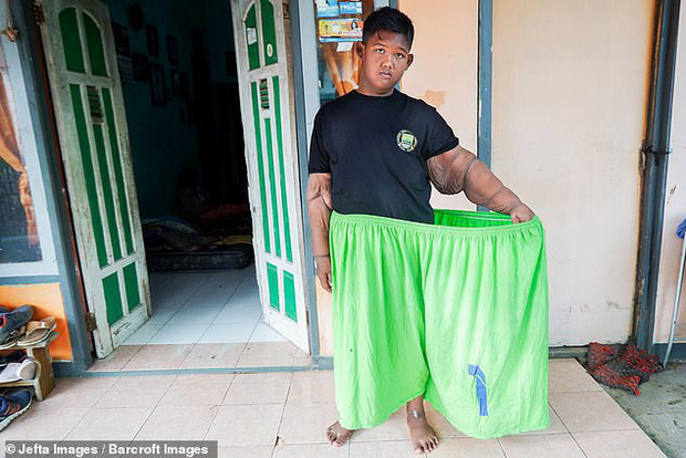Cậu bé nặng nhất thế giới với gần 200 kg sau 4 năm phẫu thuật thu nhỏ dạ dày giờ lột xác không ai nhận ra - Ảnh 6.