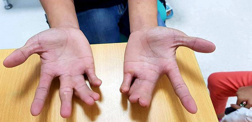 Dị tật bàn tay càng tôm hùm, bé 5 tuổi được bác sĩ tái tạo lành lặn - Ảnh 1.