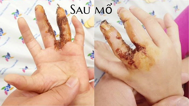 Dị tật bàn tay càng tôm hùm, bé 5 tuổi được bác sĩ tái tạo lành lặn - Ảnh 2.