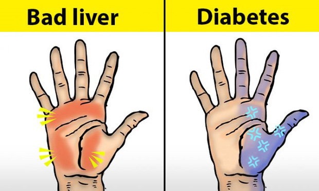 Người có chức năng gan ổn định sẽ không có 4 điểm sau trên đôi tay, cùng xem bạn có điểm nào hay không - Ảnh 1.