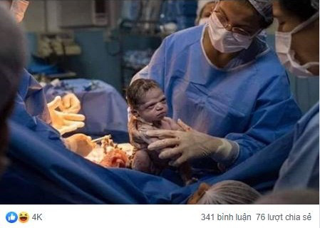 Hình ảnh em bé vừa chào đời đã lườm xắt xéo bác sĩ khiến cư dân mạng được một trận cười thả ga - Ảnh 1.