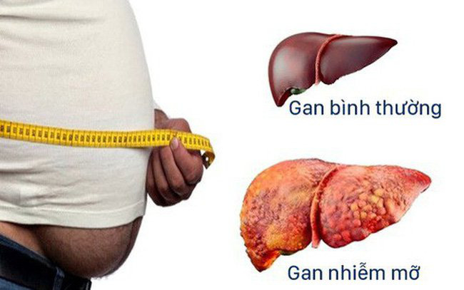 Dấu hiệu gan nhiễm mỡ có quá nguy hiểm? - Ảnh 1.