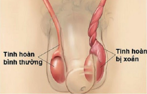 Đau bẹn đùi mà chủ quan không khám, nam sinh phải cắt bỏ tinh hoàn vì hoại tử - Ảnh 1.