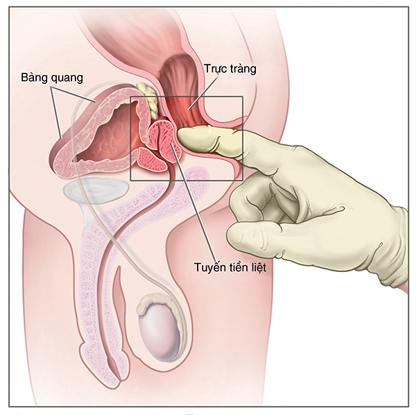 Những dấu hiệu u xơ tuyến tiền liệt - Ảnh 2.