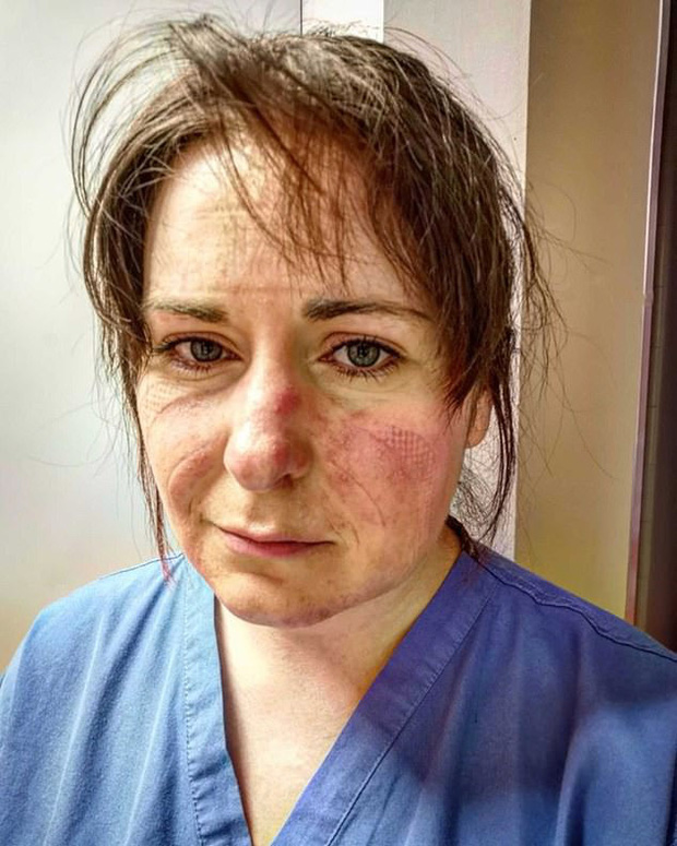 Nữ y tá xinh đẹp chia sẻ hình ảnh gương mặt biến dạng, đã đi qua địa ngục sau 65 tiếng làm việc và lời khẩn cầu dành cho tất cả mọi người - Ảnh 3.