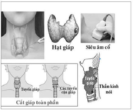 Ai dễ bị ung thư tuyến giáp? - Ảnh 1.