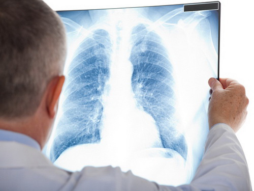 Tầm soát ung thư phổi - giảm thiểu nguy cơ tử vong - Ảnh 1.