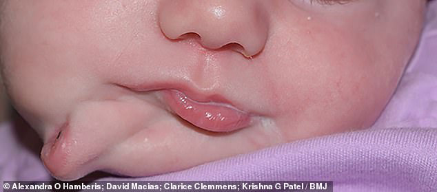Vừa mới chào đời, bé gái đã khiến các bác sĩ kinh ngạc khi có đến 2 cái miệng trên mặt  - bệnh lý vô cùng hiếm gặp - Ảnh 1.