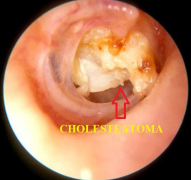 Tai có mùi hôi thối - triệu chứng của nhiều bệnh lý nguy hiểm - Ảnh 2.