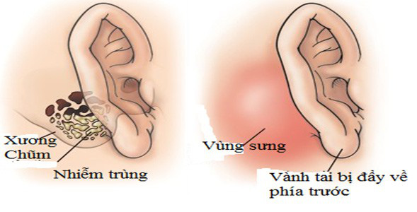 Tai có mùi hôi thối - triệu chứng của nhiều bệnh lý nguy hiểm - Ảnh 4.