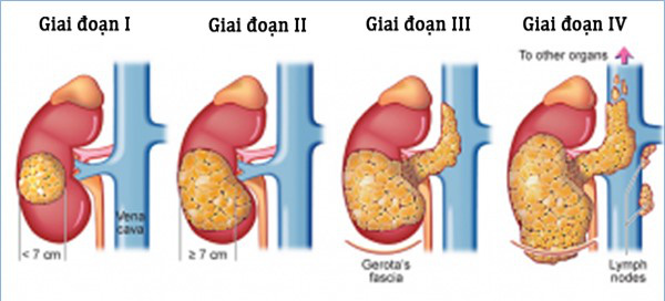 Mách bạn nhận biết sớm ung thư thận - Ảnh 1.