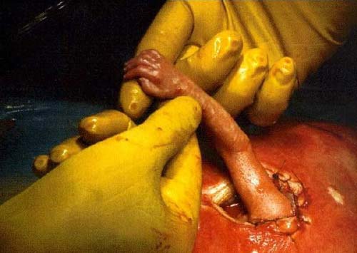 Thai nhi thò tay ra tử cung, nắm tay bác sỹ