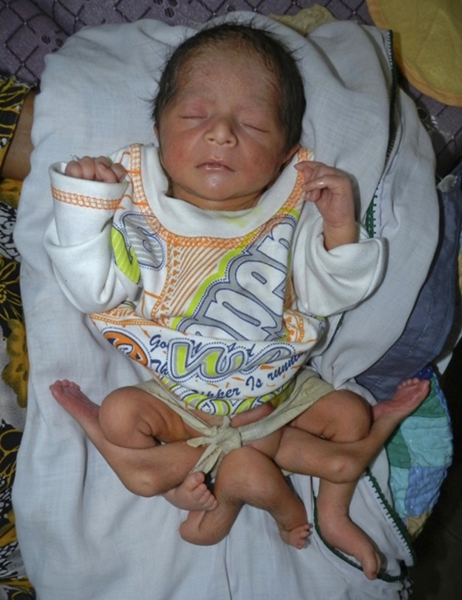 Bé trai có 6 chân vừa chào đời tại Pakistan.