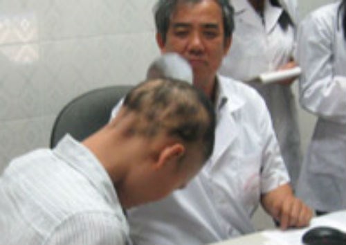 Một trường hợp bị rụng tóc từng mảng được bác sĩ Nguyễn Thành khám