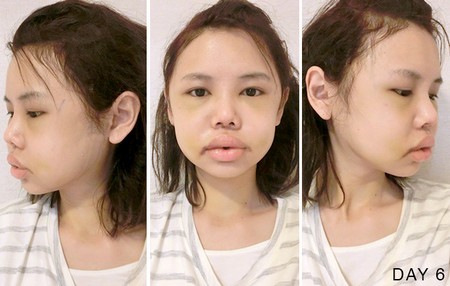Hot girl Singapore công khai loạt ảnh sưng phù do phẫu thuật thẩm mỹ 10