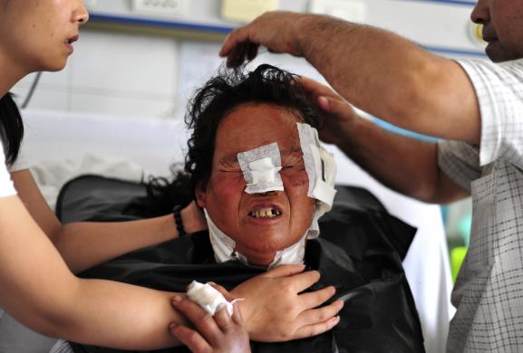 Bệnh nhân bị chó sói cắn phản ứng lại khi bác sĩ tại bệnh viện ở Urumqi, Tân Cương, cắt tóc cho bà để giữ tóc khỏi chạm vào vết thương ở cổ. 