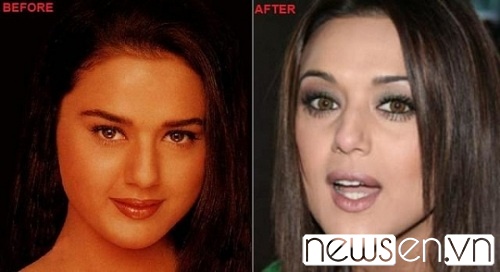 preity-zinta-before-and-after-surgery