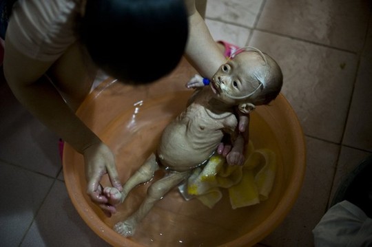 Hình ảnh Mắc bệnh lạ, bé gái 1 tuổi nặng 3kg giống y người ngoài hành tinh số 3