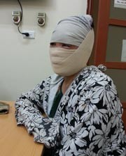 Bà Lê Thị Toan, nạn nhân một vụ tạt axít 4 tháng trước.