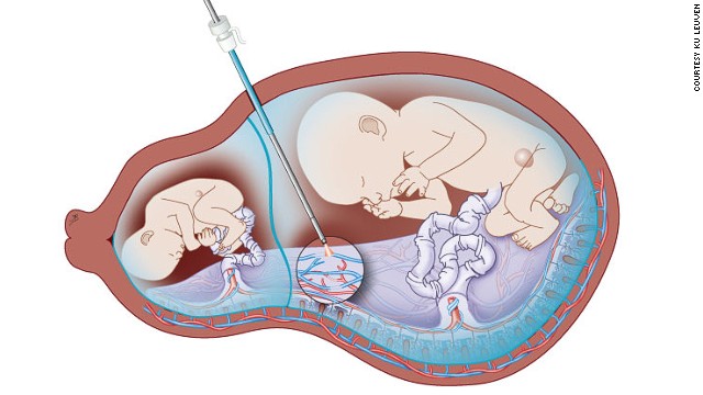 Rô bốt phẫu thuật có thể khắc phục tình trạng lượng máu tryền không cân bằng giữa cặp thai nhi song sinh. Ảnh:CNN.