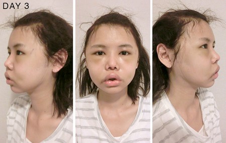 Hot girl Singapore công khai loạt ảnh sưng phù do phẫu thuật thẩm mỹ 7