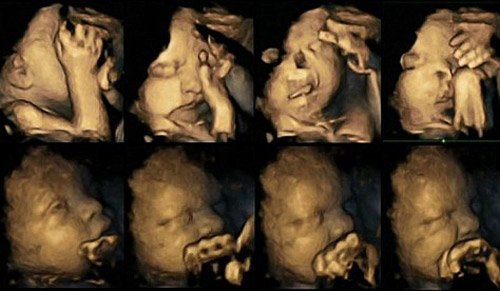 Hình ảnh thai nhi đang nhăn nhó trong bụng mẹ bầu hút thuốc lá. Bên dưới là hình ảnh thai nhi phát triển bình thường (Ảnh: The Telegraph)