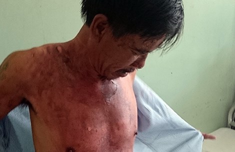 Nạn nhân Nguyễn Văn Lộc tại bệnh viện. Ảnh: CTV