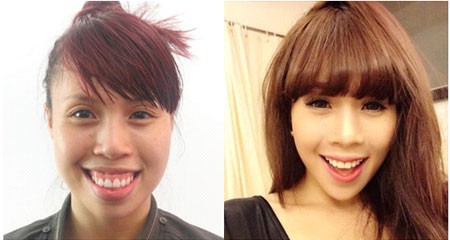 Khuôn mặt của Lan trước và sau khi phẫu thuật hàm hô tại Thẩm mỹ viện Hàn Quốc.
