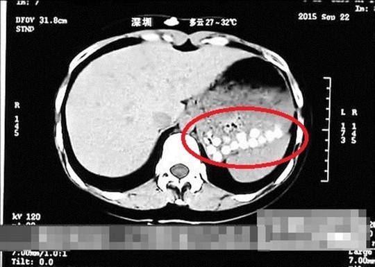 
Kết quả CT scan dạ dày của phóng viên này tại bệnh viện cho thấy những viên trân châu dồn lại một chỗ, không thể tiêu hóa được.
