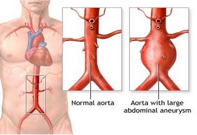
Hình ảnh động mạch chủ bình thường và động mạch chủ bị phình.
