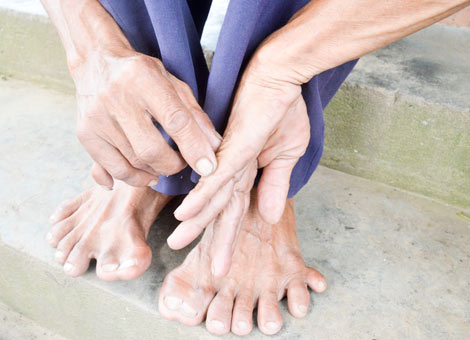 
Đôi bàn tay, bàn chân nhiều ngón kỳ dị của ông Lực. Ảnh: Công an nhân dân
