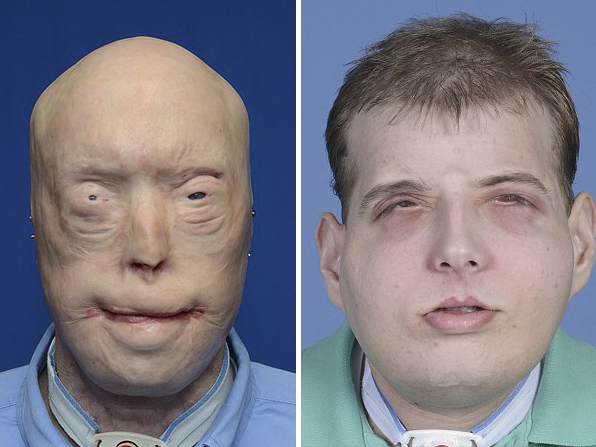 
Cựu lính cứu hỏa Pat Hardison được trao cho khuôn mặt mới sau 14 năm chờ đợi.
