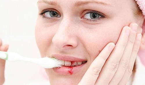 
Chảy máu chân răng là dấu hiệu cảnh báo về bệnh viêm lợi hay bệnh nha chu.
