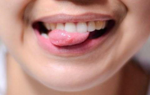 Lưỡi mịn màng có thể bạn đang thiếu B12