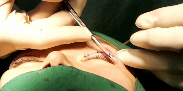 
Phẫu thuật làm mắt hai mí là loại tiểu phẫu thẩm mỹ được ưa chuộng nhất Hàn Quốc và trên thế giới.
