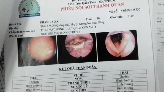 Con đỉa bám cuống họng bệnh nhân mà các bác sĩ lần đầu mới gặp.