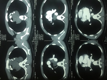 Chụp CT- Scan phát hiện bệnh nhân có khối u lớn ở vùng trung thất.