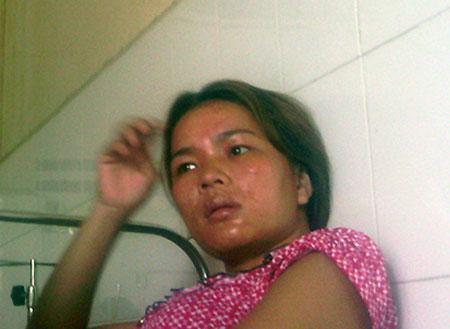 Chị Chinh sợ hãi nhớ lại thời điểm phát hiện ra 2 mẹ con bị tạt axít.