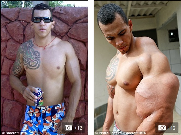 Alves trước và sau khi bơm synthol
