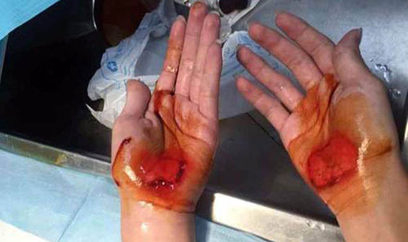 
Học sinh bị giáo viên thể dục phạt đi bằng tay đến tứa máu.
