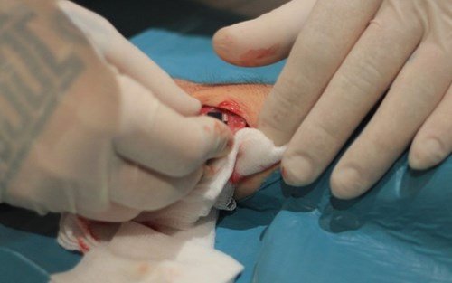 
Quá trình tiểu phẫu vô cùng đau đớn do vùng da tại mu bàn tay mỏng, có nhiều mach máu
